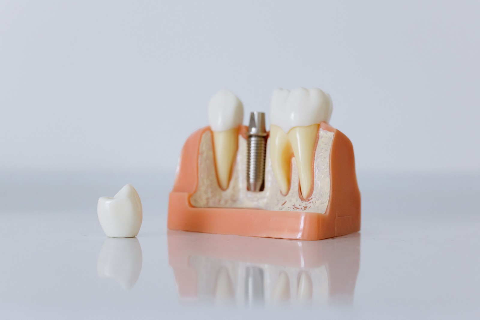 Modèle d'implant dentaire en coupe avec couronne céramique