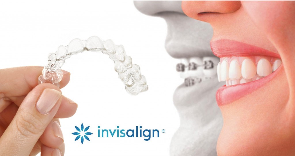 Gouttière transparente Invisalign